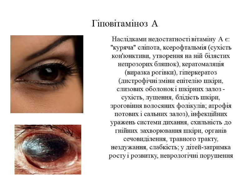 Гіповітаміноз А Наслідками недостатності вітаміну А є: 